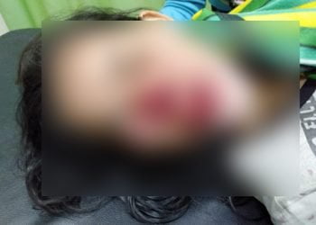 Hendak Jaga Durian Seorang Wanita di Aceh Timur Digigit Orangutan