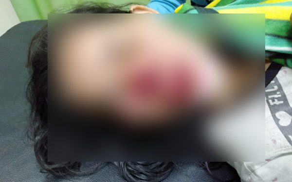 Hendak Jaga Durian Seorang Wanita di Aceh Timur Digigit Orangutan